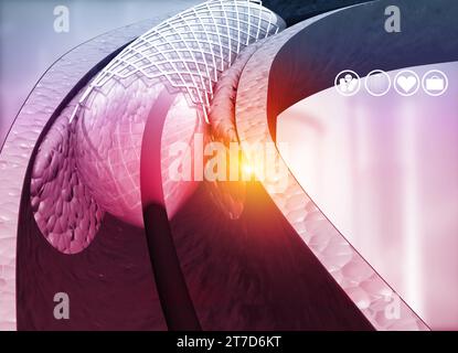 Human heart angioplasty. 3d illustration Stock Photo