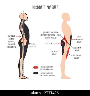 Posture disorders infographics. Lordotic posture. Side view shows hyperlordosis deformation, spine curvature, pelvis rotation, stretched and weakened, shortened and tens muscles. Vector illustration. Stock Vector
