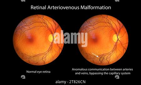 Retinal arteriovenous malformation, illustration Stock Photo