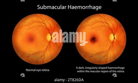 Submacular haemorrhage on the retina, illustration Stock Photo