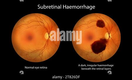 Subretinal haemorrhage on the retina, illustration Stock Photo