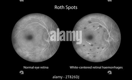 Roth spots in the retina, illustration Stock Photo