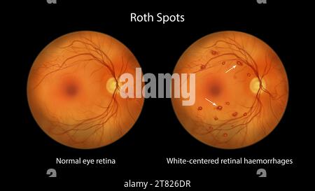 Roth spots in the retina, illustration Stock Photo