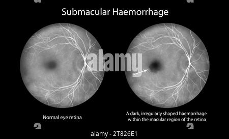 Submacular haemorrhage on the retina, illustration Stock Photo