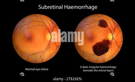 Subretinal haemorrhage on the retina, illustration Stock Photo