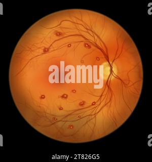 Roth spots in the retina, illustration Stock Photo