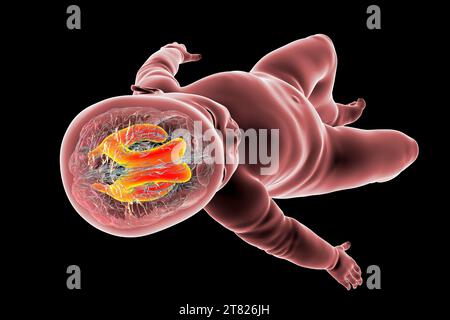 Baby with enlarged lateral ventricles, illustration Stock Photo