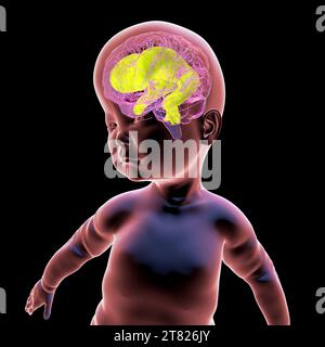 Baby with enlarged brain ventricles, illustration Stock Photo