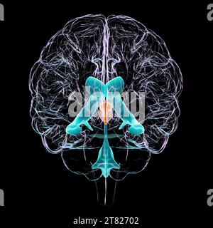 Enlarged third ventricle of the brain, illustration Stock Photo