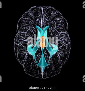 Enlarged third ventricle of the brain, illustration Stock Photo