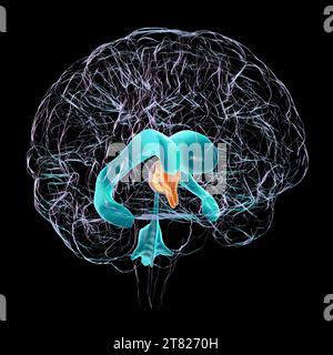 Enlarged third ventricle of the brain, illustration Stock Photo