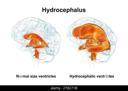 Enlarged and normal brain ventricles, illustration Stock Photo