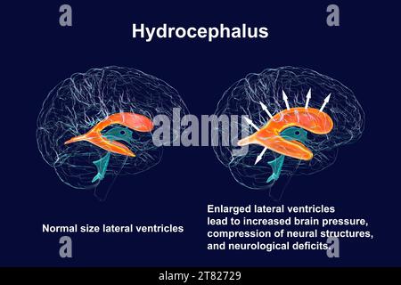 Enlarged and normal brain lateral ventricles, illustration Stock Photo