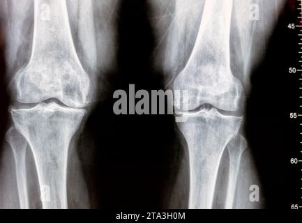 Plain X ray of both knee joints shows apparent joint osteoarthritis ...