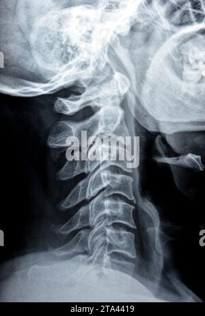 Plain X ray of cervical spine revealed straightened cervical curve, spondylosis osteophytic lipping of C3, C4, C5 vertebral end plates, narrow disc sp Stock Photo