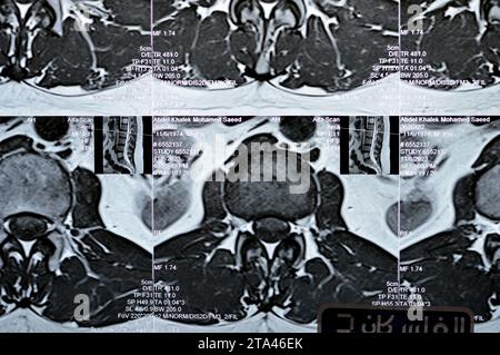 Affaking Cairo, Egypt, November 14 2023: MRI of lumbosacral spine revealed L3-L4 ...