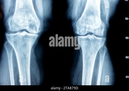 Plain X ray of both knee joints shows apparent joint osteoarthritis ...