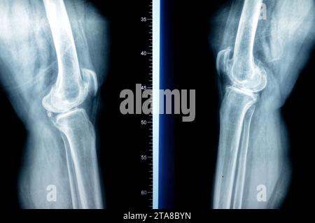 Plain X ray of both knee joints shows apparent joint osteoarthritis ...