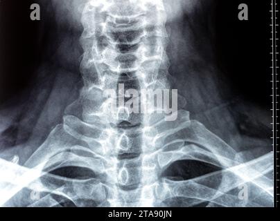 Plain X ray of cervical spine revealed straightened cervical curve, spondylosis osteophytic lipping of C3, C4, C5 vertebral end plates, narrow disc sp Stock Photo
