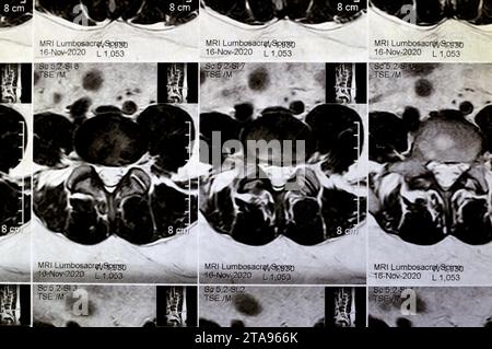 MRI lumbosacral spine without contrast revealed back muscle spasm, Mild L3-L4, L4-L5 disc lesions, Sacral, L5 and T12 vertebral bodies haemangiomata, Stock Photo