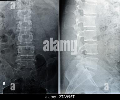 Plain X ray lumbosacral spine revealed straightened, mild scoliotic ...