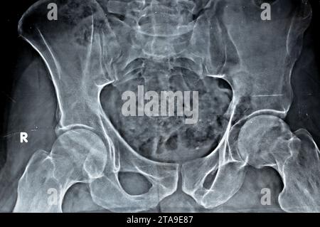 Plain X-ray of both hip joints revealed slight narrowing of superolateral aspect of both hip joints spaces with subchondral sclerosis of the opposed a Stock Photo