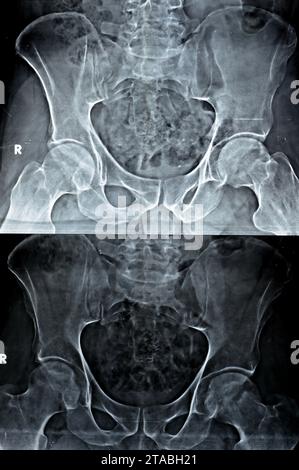 Plain X-ray of both hip joints revealed slight narrowing of superolateral aspect of both hip joints spaces with subchondral sclerosis of the opposed a Stock Photo