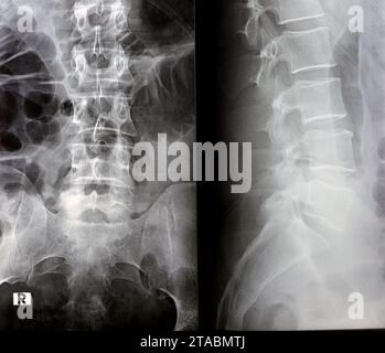 Lumbosacral spine digital radiographic examination reveals  straightened lumber lordotic curve, marginal osteophytic lipping of L4 vertebral end plate Stock Photo