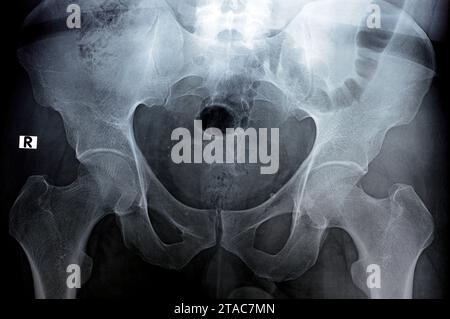 Hip joints digital radiographic examination reveals normal appearance ...