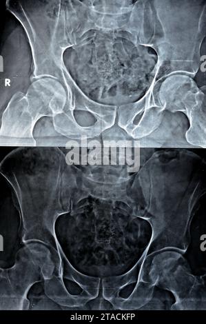 Plain X-ray of both hip joints revealed slight narrowing of superolateral aspect of both hip joints spaces with subchondral sclerosis of the opposed a Stock Photo