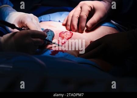 Rendsburg, Germany. 29th Nov, 2023. Two doctors perform an abdominal operation in the Schön Klinik's surgery center. Credit: Frank Molter/dpa/Ģ����ý Live News Stock Photo
