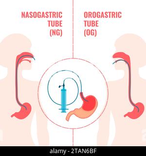 Enteral feeding tubes, conceptual illustration Stock Photo