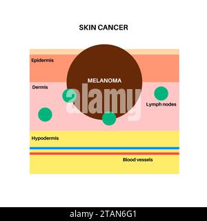 Melanoma cell a type of skin cancer closeup view 3d illustration Stock ...
