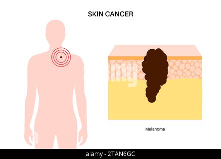 Melanoma cell a type of skin cancer closeup view 3d illustration Stock ...