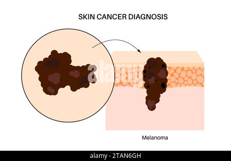 Melanoma cell a type of skin cancer top view 3d illustration Stock ...