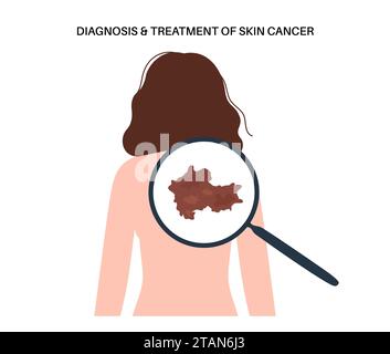 Melanoma cell a type of skin cancer closeup view 3d illustration Stock ...