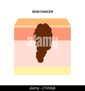 Melanoma cell a type of skin cancer isometric view 3d illustration ...