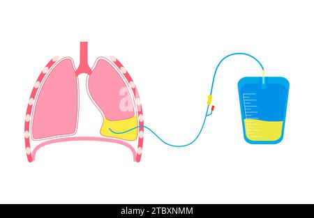 Thoracentesis medical procedure, illustration Stock Photo