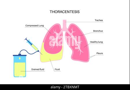 Thoracentesis medical procedure, illustration Stock Photo