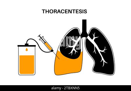 Thoracentesis medical procedure, illustration Stock Photo