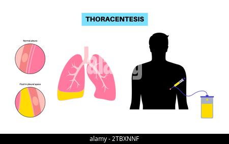 Thoracentesis medical procedure, illustration Stock Photo