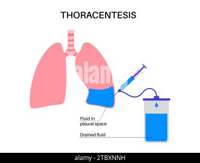 Thoracentesis medical procedure, illustration Stock Photo