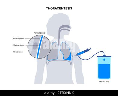 Thoracentesis medical procedure, illustration Stock Photo