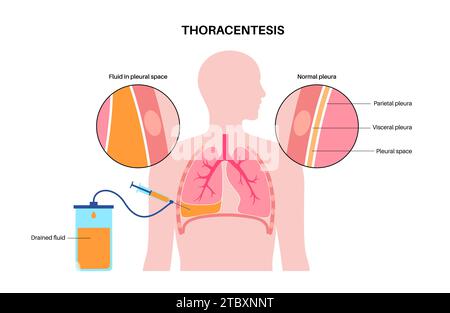 Thoracentesis medical procedure, illustration Stock Photo