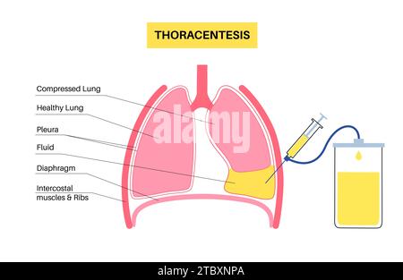 Thoracentesis medical procedure, illustration Stock Photo