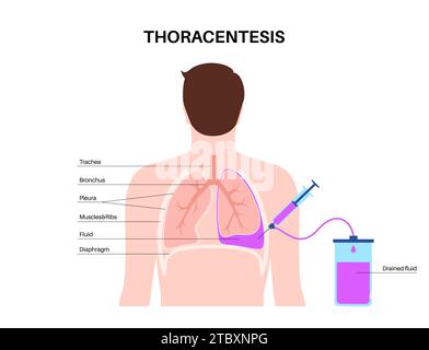 Thoracentesis medical procedure, illustration Stock Photo