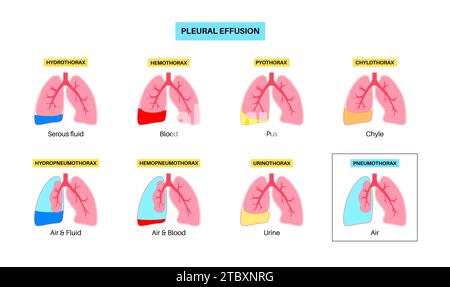 Pleural effusion and pneumothorax, illustration Stock Photo - Alamy