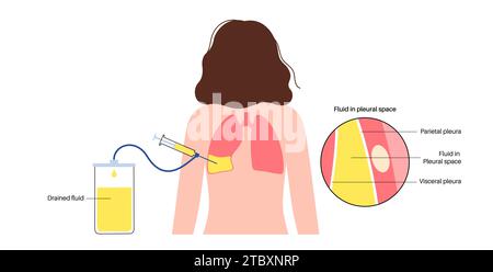 Thoracentesis medical procedure, illustration Stock Photo