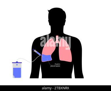 Thoracentesis medical procedure, illustration Stock Photo