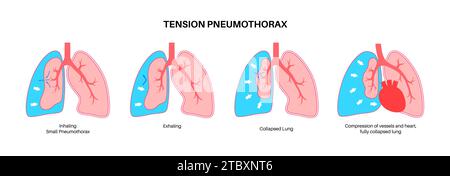 Tension pneumothorax, illustration Stock Photo - Alamy